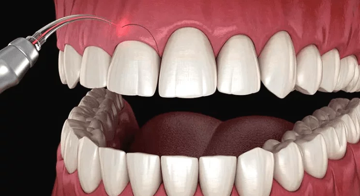 Gum symmetry — gum aesthetics treatment Kerala